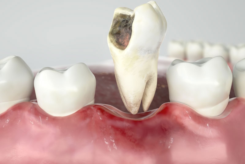 damaged tooth graphic