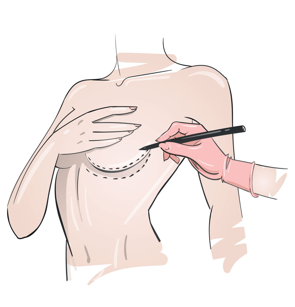 breast augmentation drawing