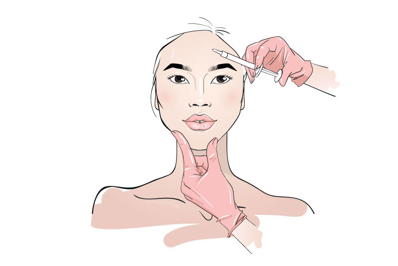 juvederm drawing