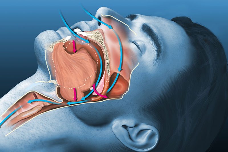 sleep apnea