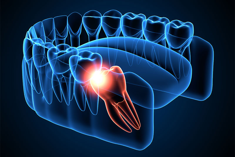 wisdom tooth graphic