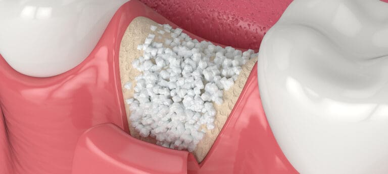 Dental Bone Grafting in Issaquah, WA