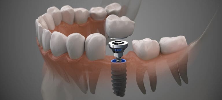 Dental Implants
