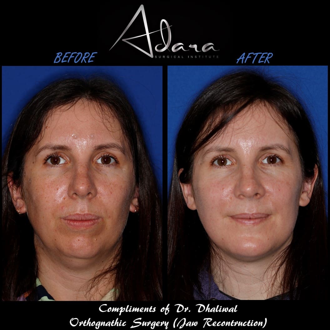 Jaw surgery before and after