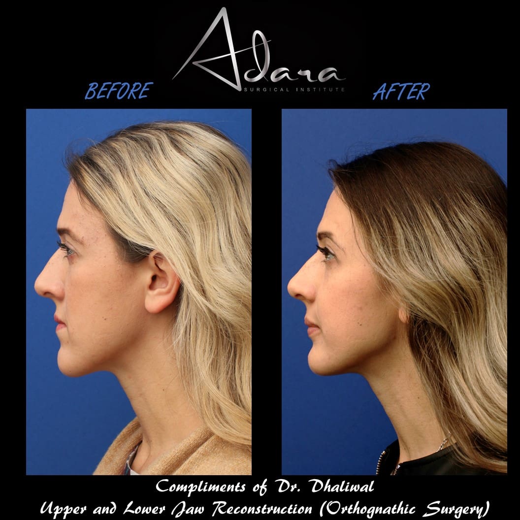 Jaw surgery before and after