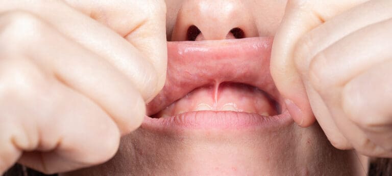 Frenectomy in Issaquah, WA Frenectomy in Issaquah, WA