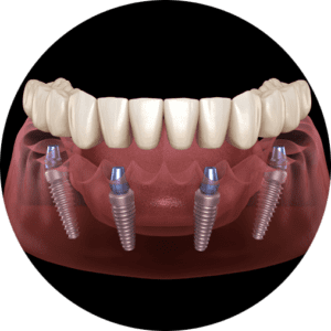 Full Mouth Dental Implants