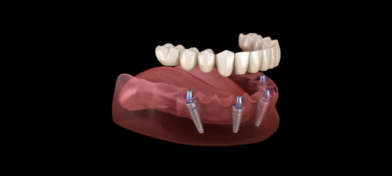 Full Mouth Dental Implants in Issaquah, WA
