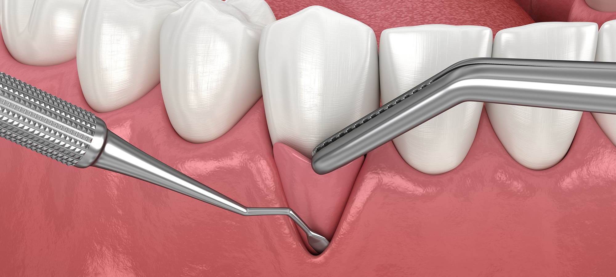 Soft Tissue Grafting in Issaquah, WA