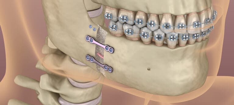 Orthognathic (Jaw) Surgery in Issaquah, WA
