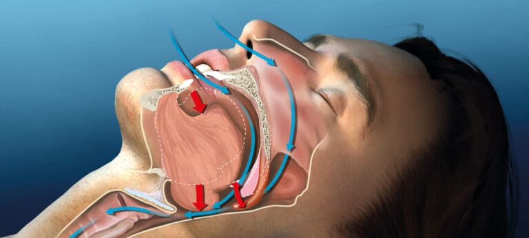 Surgical Sleep Apnea Treatment in Issaquah, WA