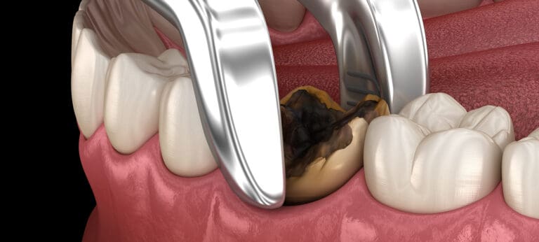 Dental Extractions in Issaquah, WA