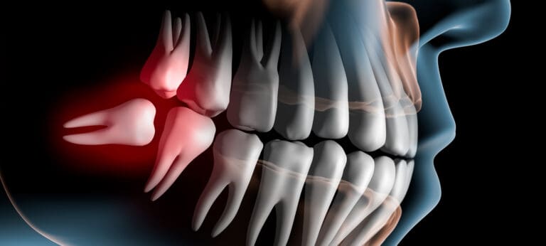 Wisdom Teeth Removal in Issaquah, WA