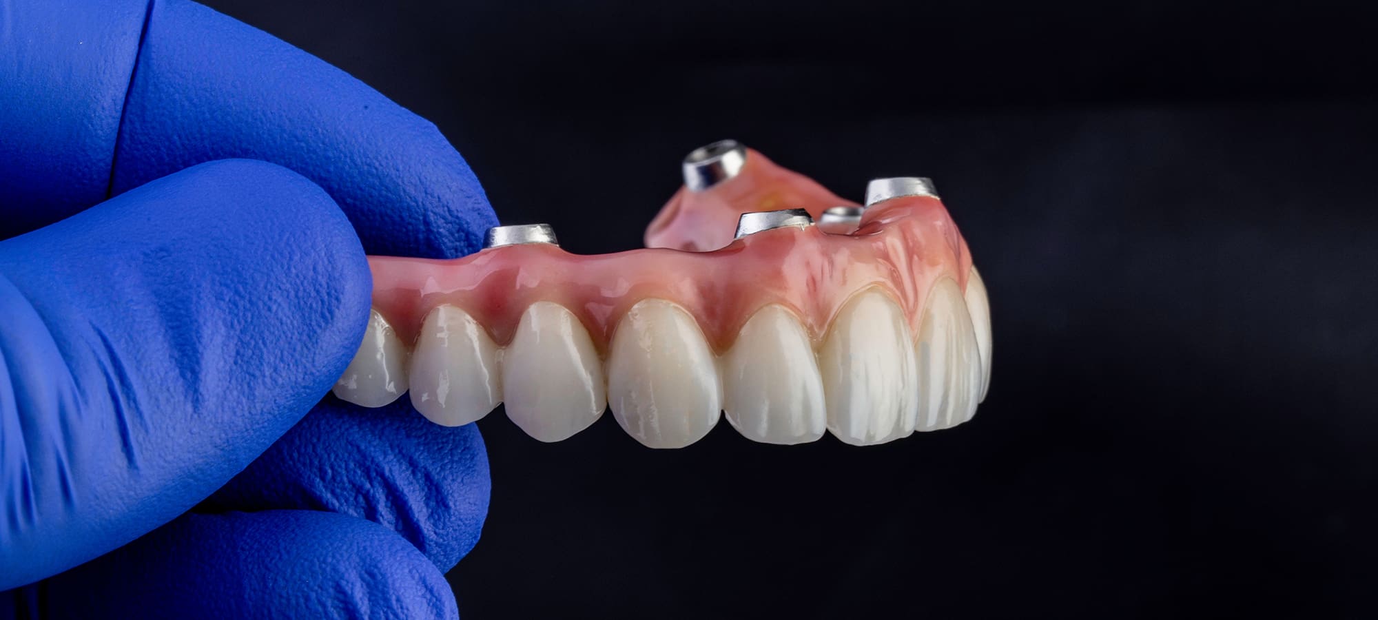 Zirconia Fixed Bridge