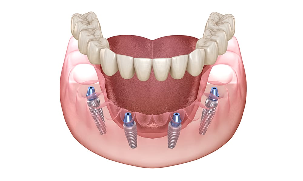 Fixed Full-Arch Dental Implants (Permanent, Non-Removable)