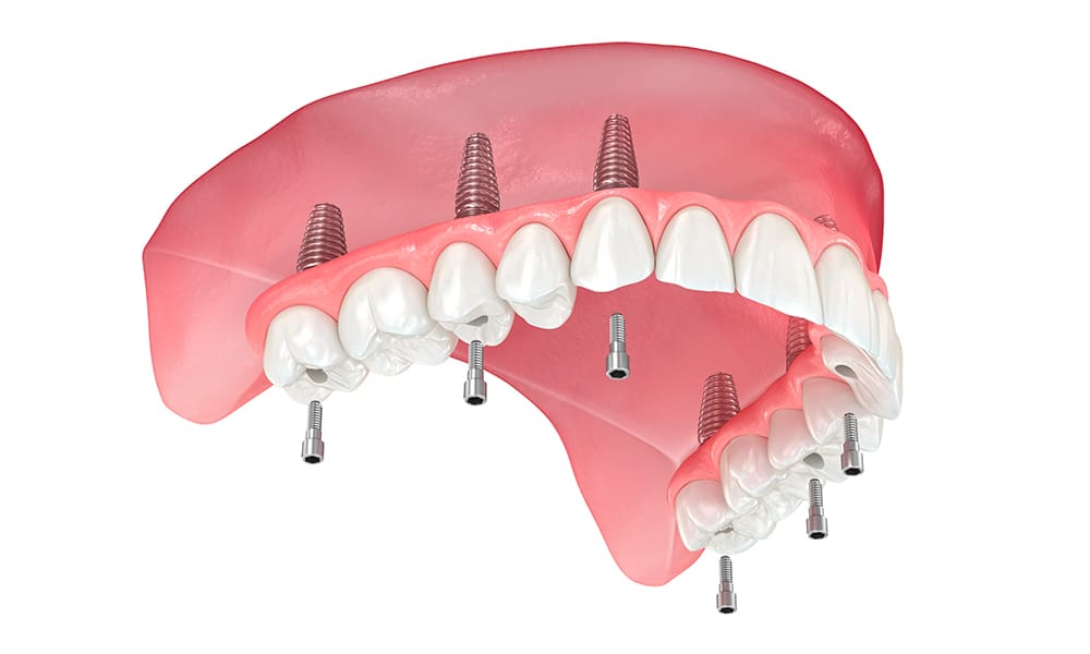 Implant-Retained Dentures (Hybrid Option)