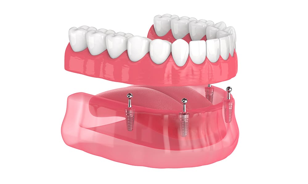 Implant-Supported Dentures (Removable)