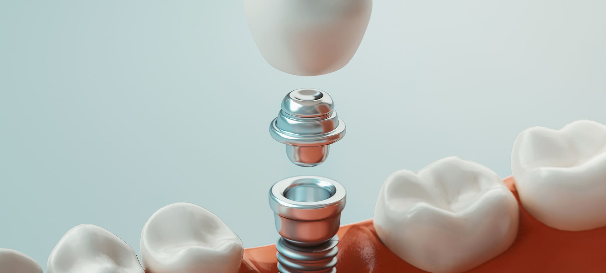 Same-Day Dental Implant: Rebecca’s Journey to a Confident Smile