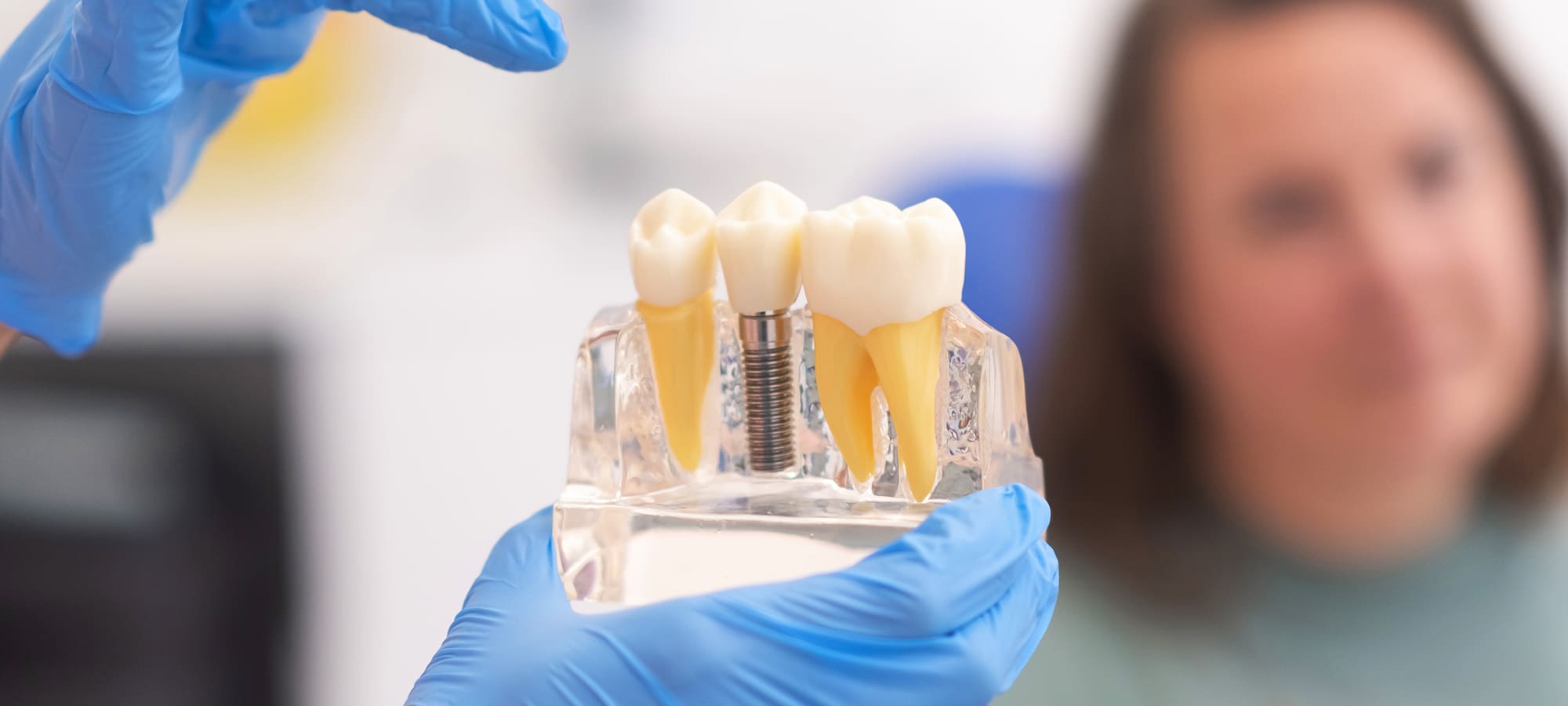 Are Dental Implants Worth It? Understanding Their Long-Term Value