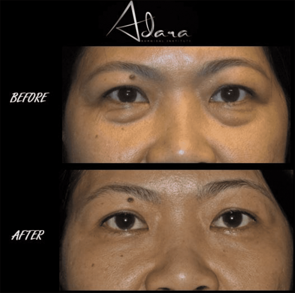 Before and after upper eyelid surgery showing reduced eyelid heaviness and more open, refreshed eyes.