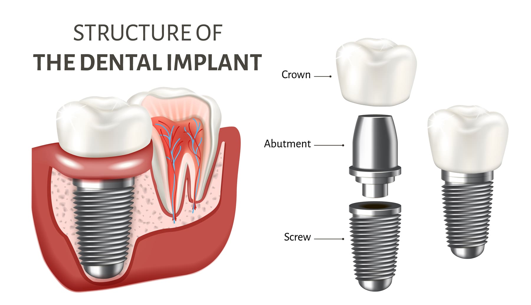 Diagram showing the structure of a dental implant, including the crown, abutment, and screw placed inside the jawbone.