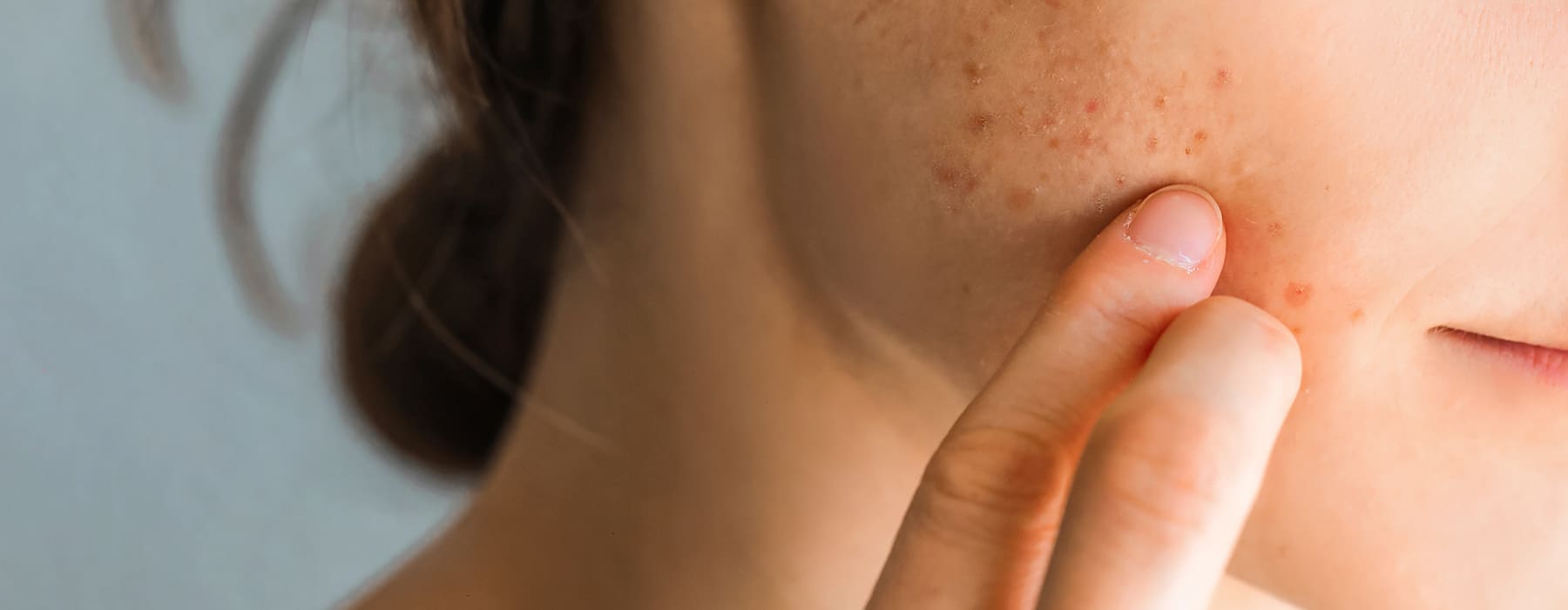 IPL for Acne: When It Helps and When It Doesn’t