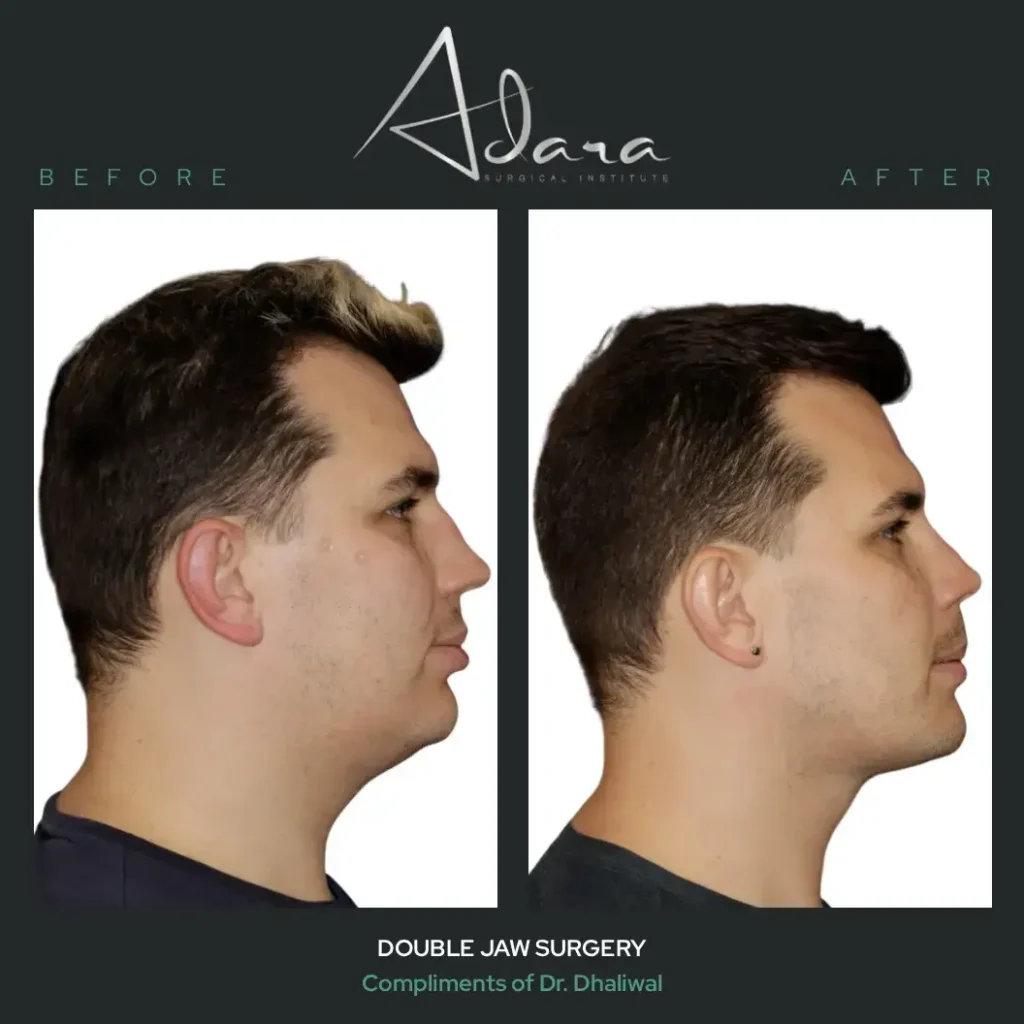 Jonathan Double Jaw Surgery 1