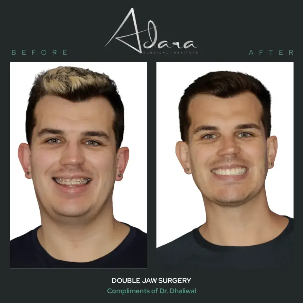 Jonathan Double Jaw Surgery 2
