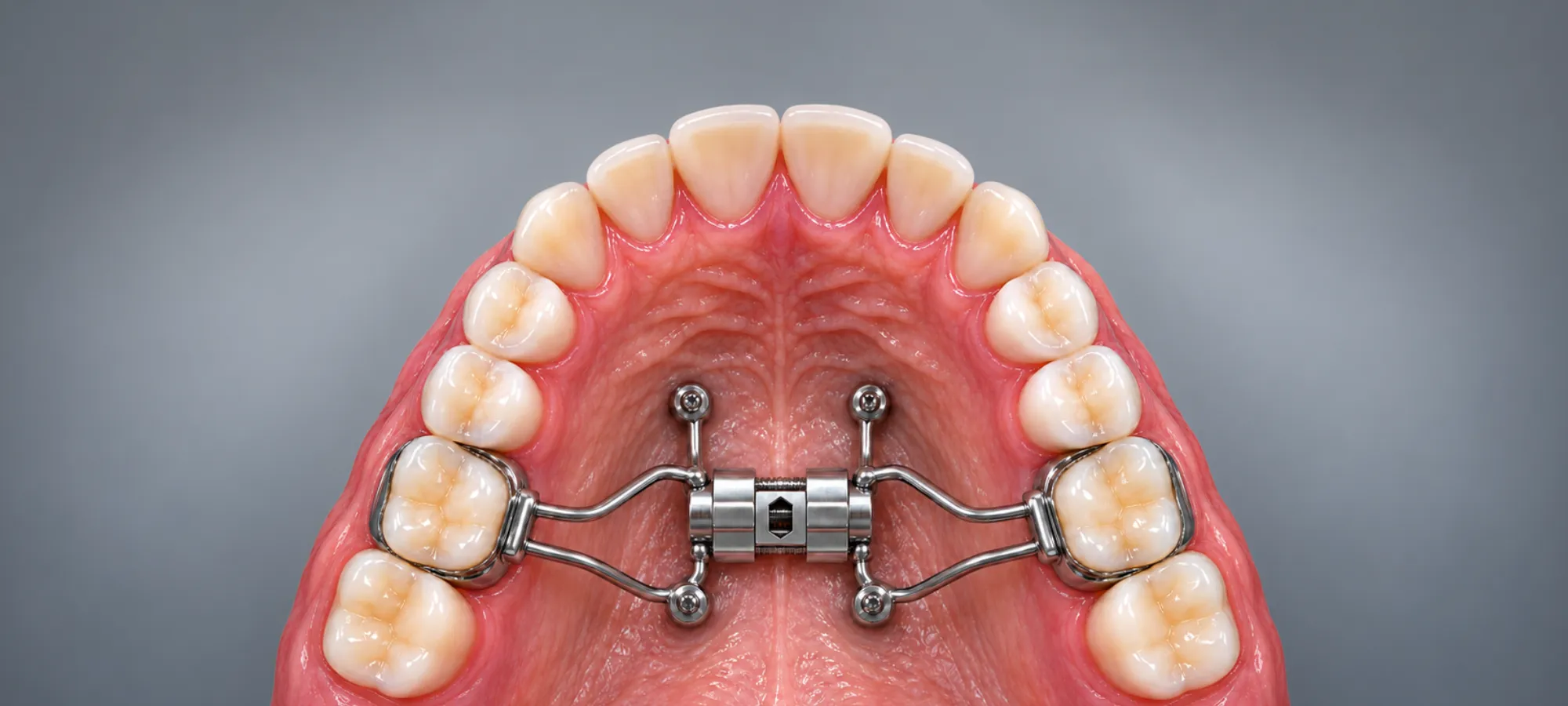 marpe palatal expansion